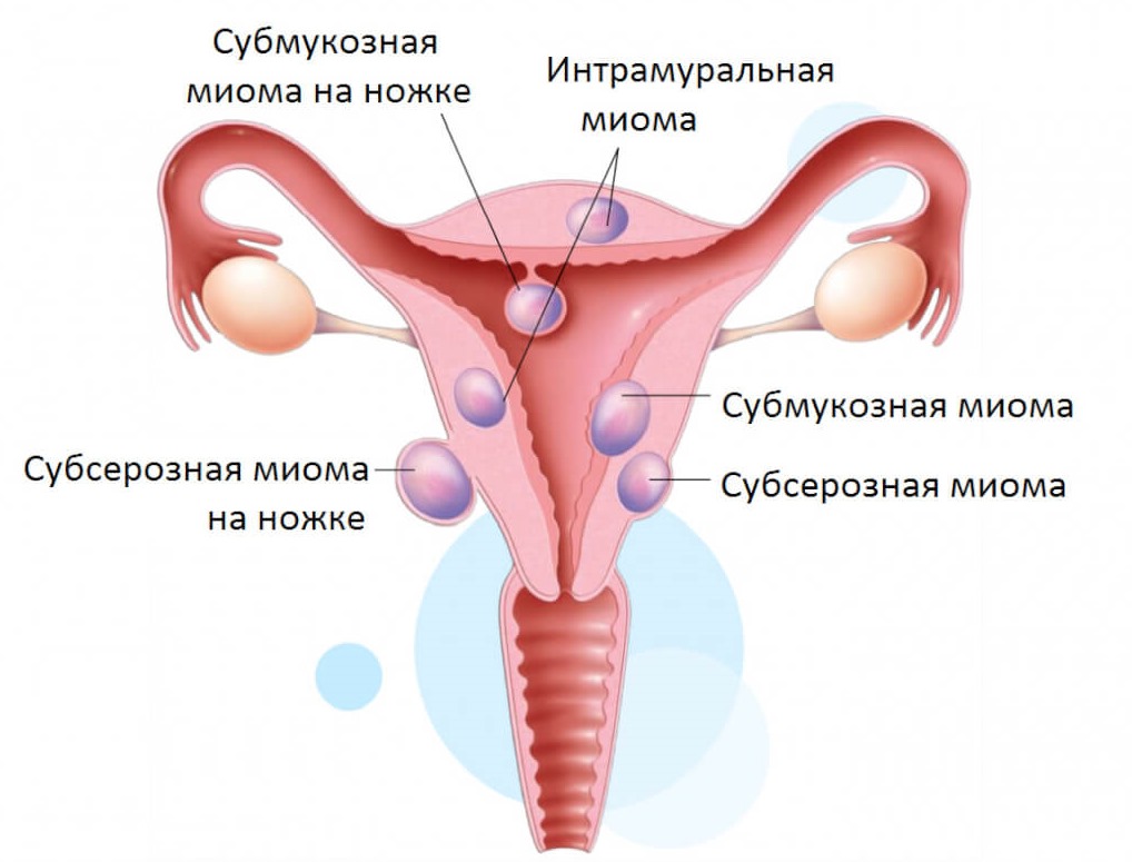 Лечение мимомы матки в Самаре. Причины, симптомы, диагностика